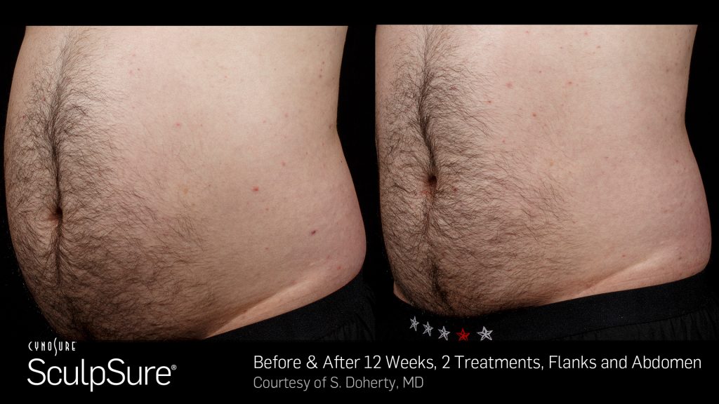 Before and after SculpSure results