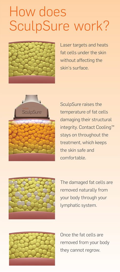 How SculpSure works